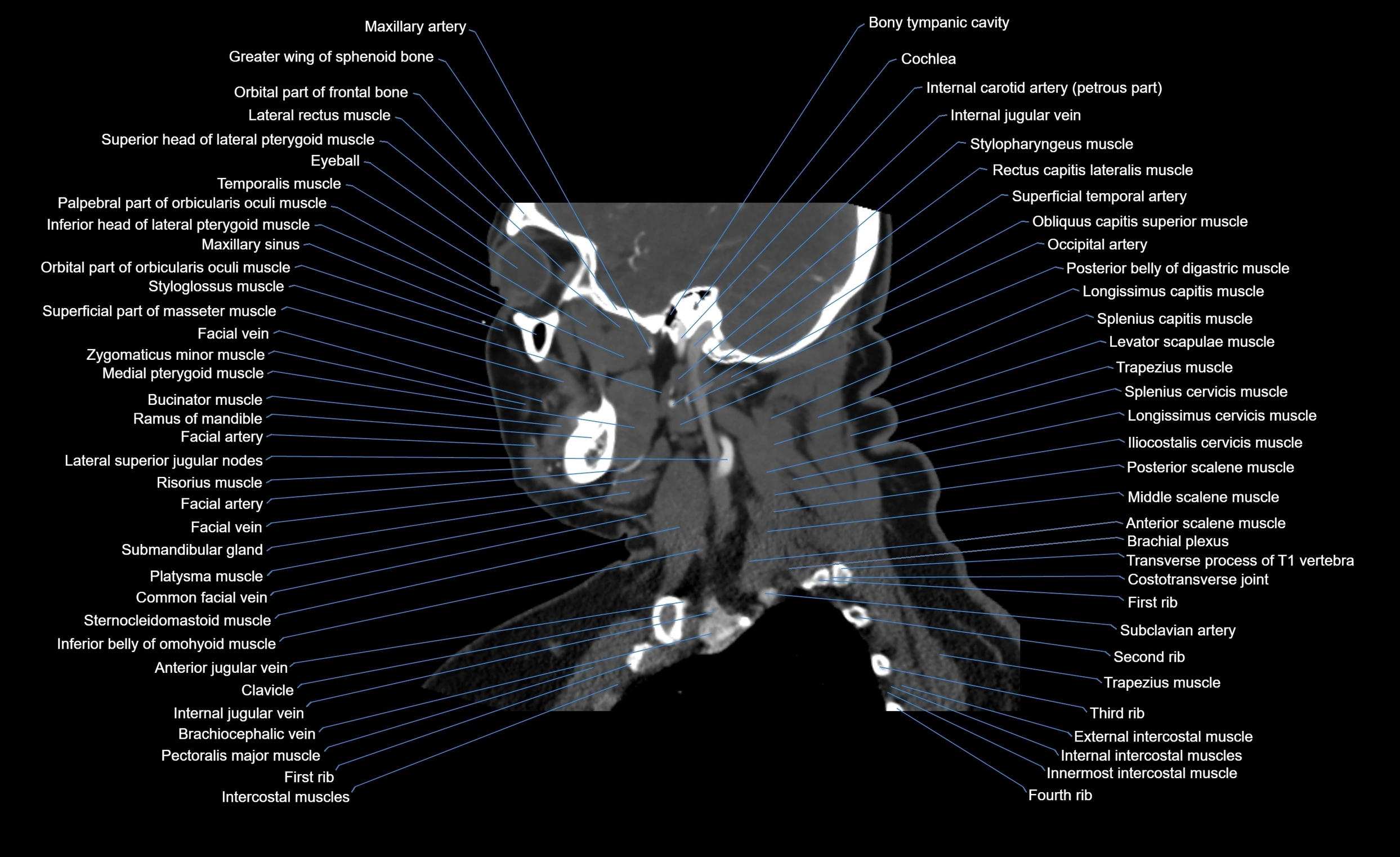 Neck CT sagittal cross sectional anatomy 3D  radiology  image-img-00001-00013.webp